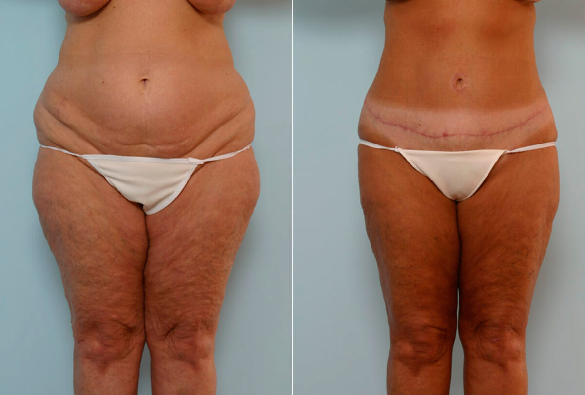 Abdominoplasty before and after photos in Houston, TX, Patient 24315