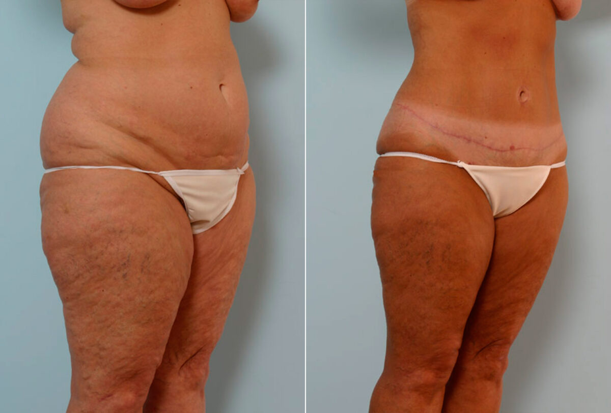 Abdominoplasty before and after photos in Houston, TX, Patient 24315