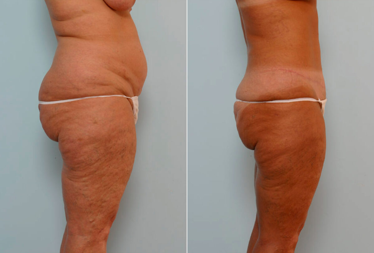 Abdominoplasty before and after photos in Houston, TX, Patient 24315