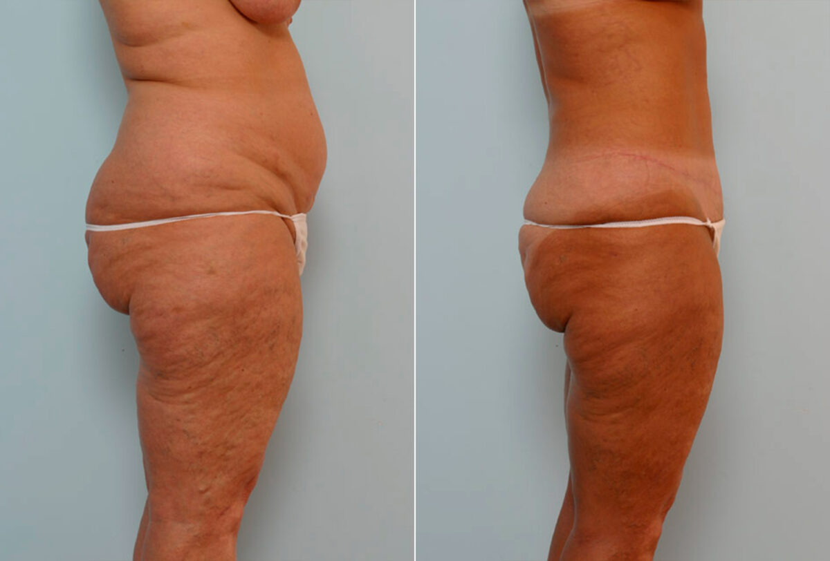 Tummy Tuck/Abdominoplasty before and after photos in Houston, TX, Patient 24315