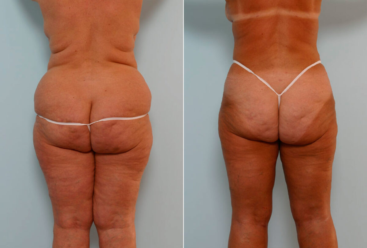 Tummy Tuck/Abdominoplasty before and after photos in Houston, TX, Patient 24315
