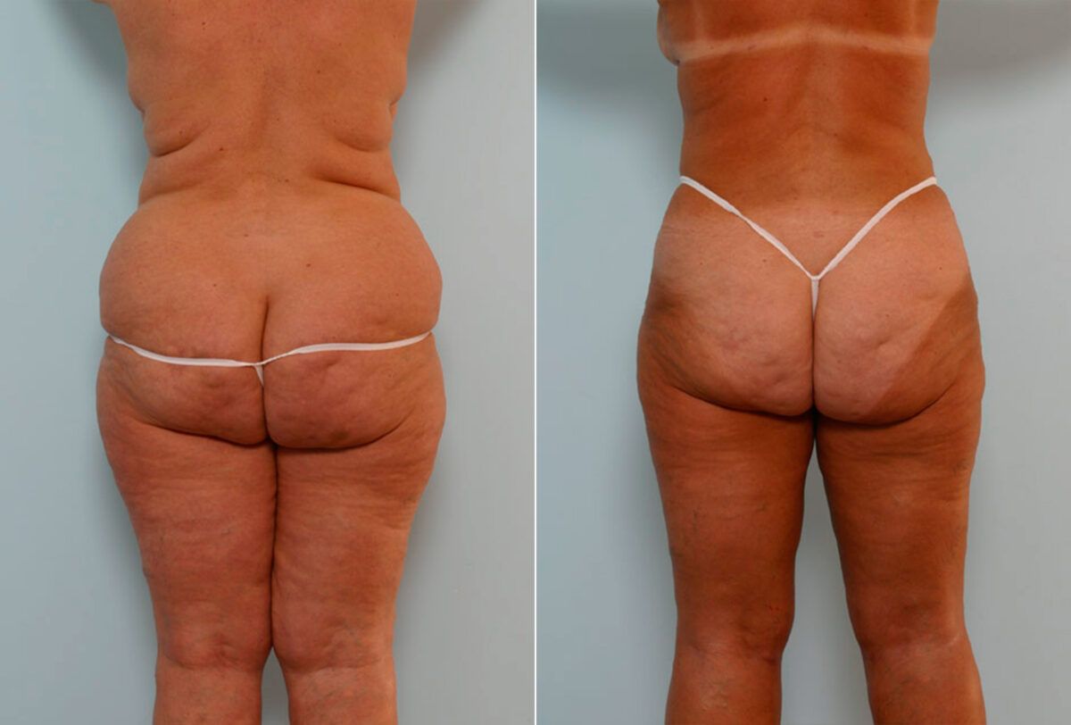 Abdominoplasty before and after photos in Houston, TX, Patient 24315