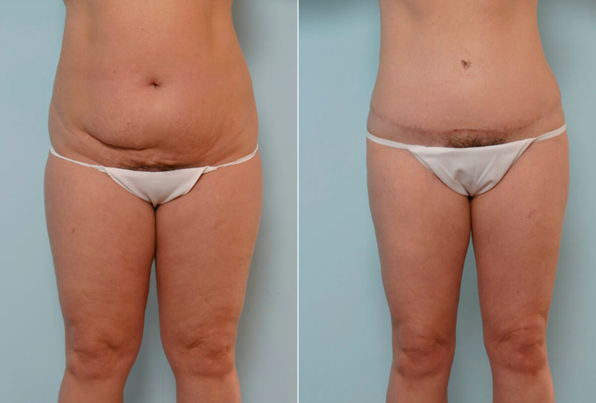 Abdominoplasty before and after photos in Houston, TX, Patient 24324