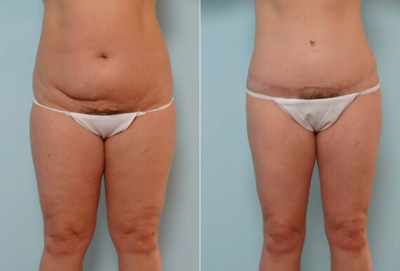 Abdominoplasty before and after photos in Houston, TX, Patient 24324