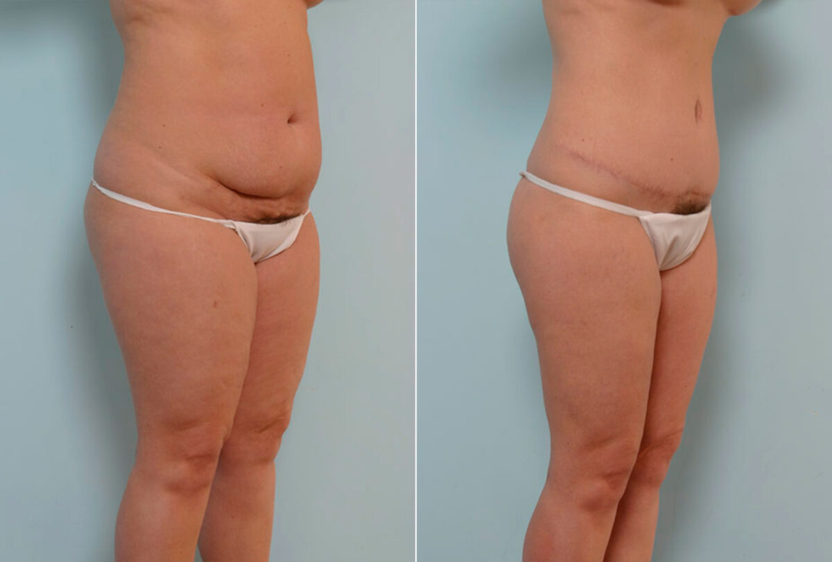 Abdominoplasty before and after photos in Houston, TX, Patient 24324