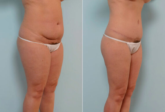 Tummy Tuck/Abdominoplasty before and after photos in Houston, TX, Patient 24324
