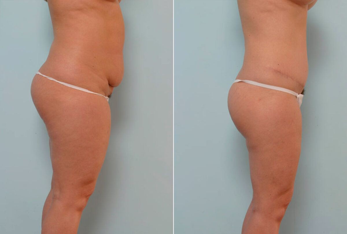 Abdominoplasty before and after photos in Houston, TX, Patient 24324