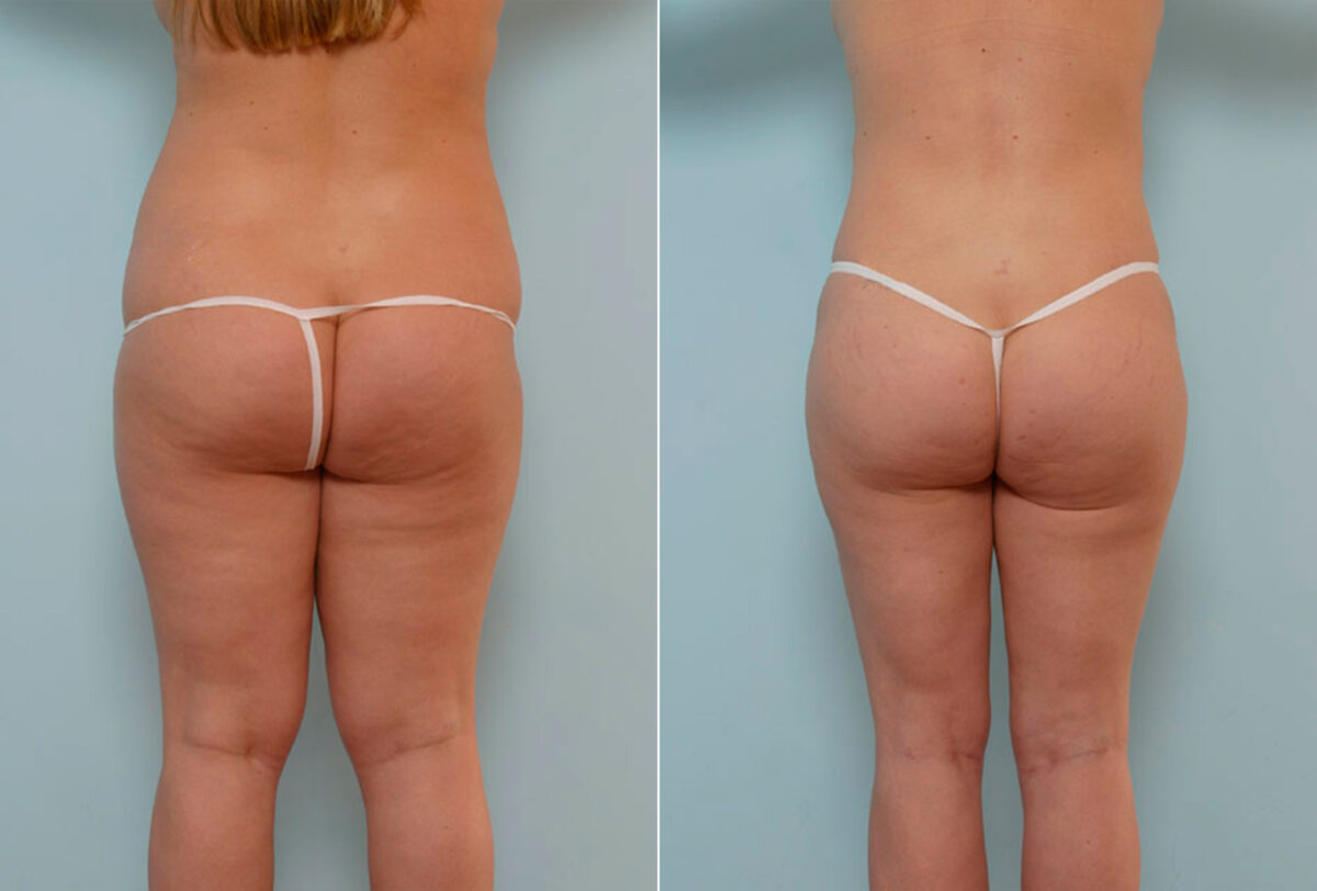 Abdominoplasty before and after photos in Houston, TX, Patient 24324