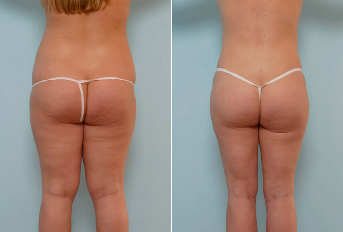 Tummy Tuck/Abdominoplasty before and after photos in Houston, TX, Patient 24324