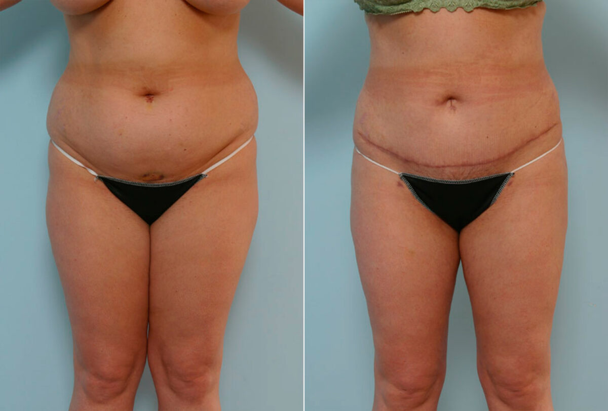 Abdominoplasty before and after photos in Houston, TX, Patient 24333