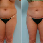 Abdominoplasty before and after photos in Houston, TX, Patient 24333