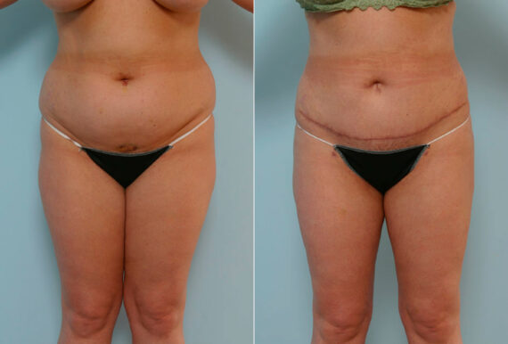 Abdominoplasty before and after photos in Houston, TX, Patient 24333