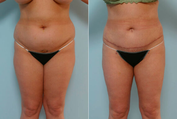 Tummy Tuck/Abdominoplasty before and after photos in Houston, TX, Patient 24333