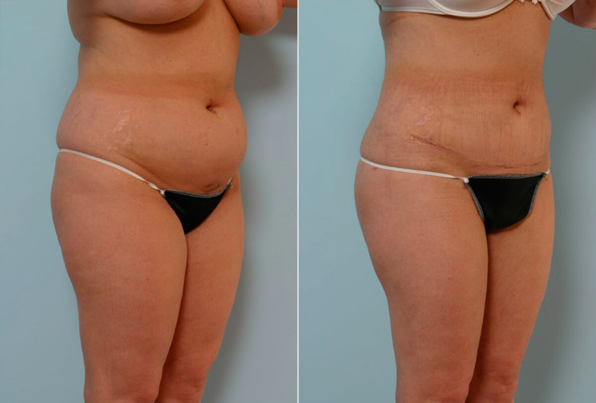Tummy Tuck/Abdominoplasty before and after photos in Houston, TX, Patient 24333