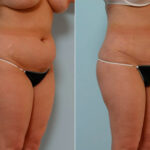 Abdominoplasty before and after photos in Houston, TX, Patient 24333