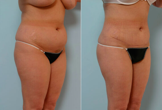 Abdominoplasty before and after photos in Houston, TX, Patient 24333