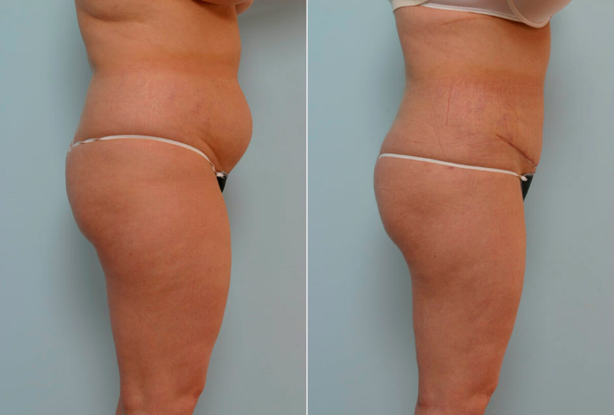 Abdominoplasty before and after photos in Houston, TX, Patient 24333