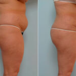 Abdominoplasty before and after photos in Houston, TX, Patient 24333