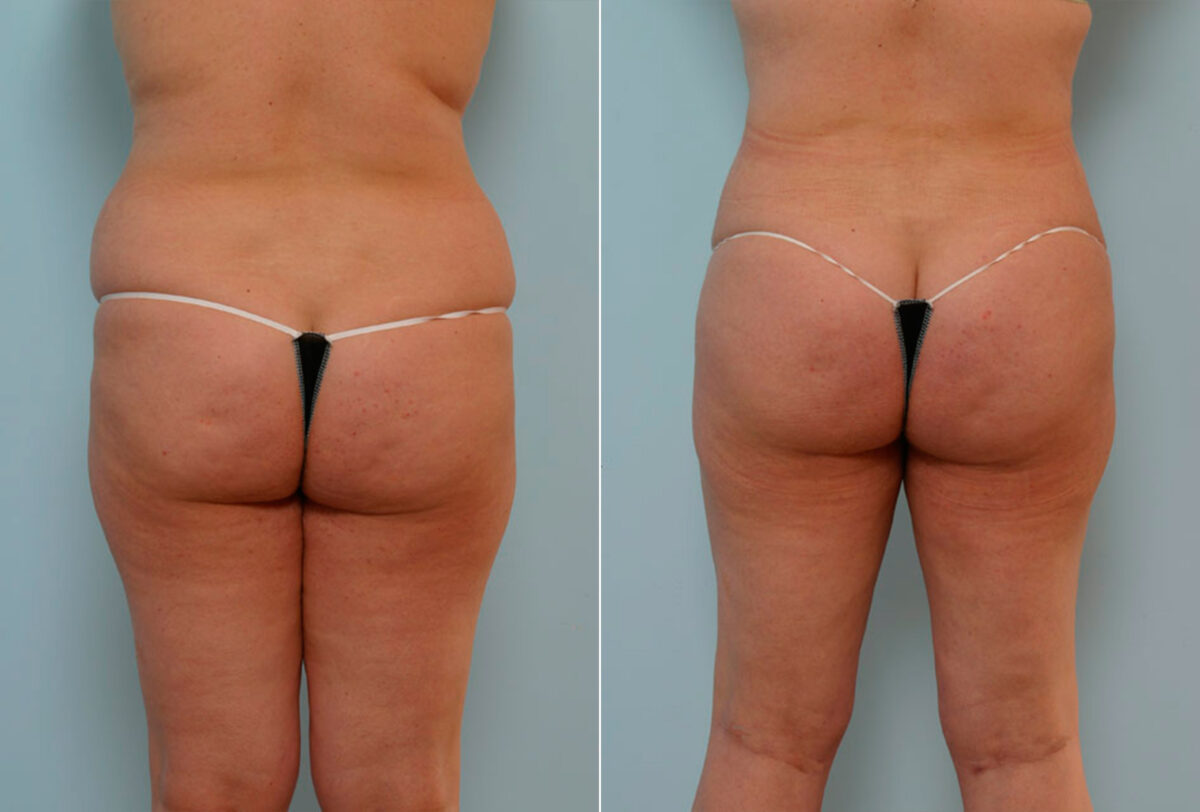 Abdominoplasty before and after photos in Houston, TX, Patient 24333