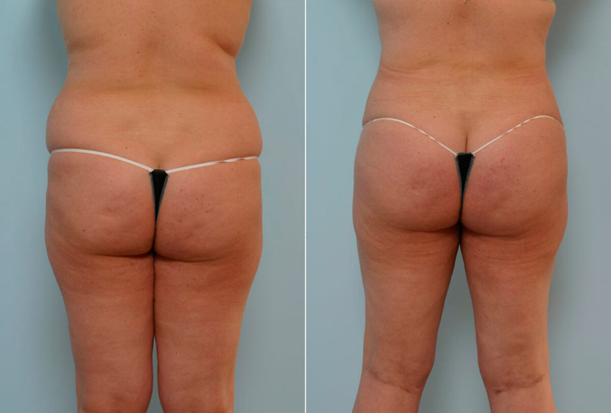 Tummy Tuck/Abdominoplasty before and after photos in Houston, TX, Patient 24333