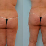 Abdominoplasty before and after photos in Houston, TX, Patient 24333