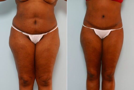 Abdominoplasty before and after photos in Houston, TX, Patient 24342