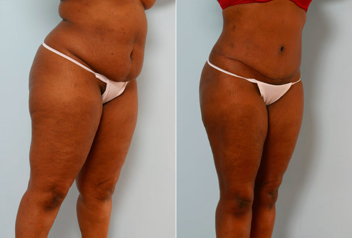 Tummy Tuck/Abdominoplasty before and after photos in Houston, TX, Patient 24342