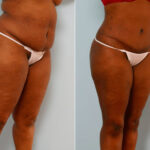 Abdominoplasty before and after photos in Houston, TX, Patient 24342