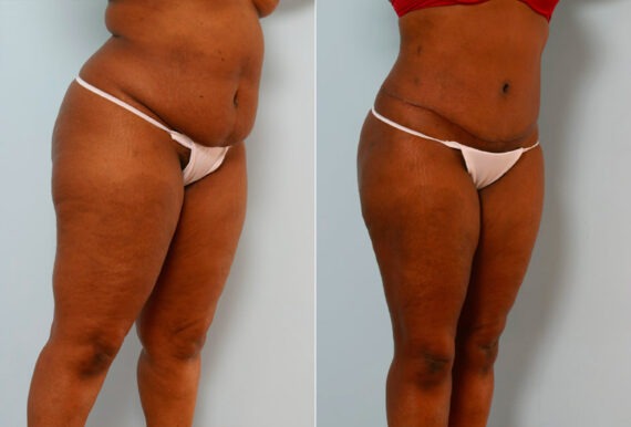 Abdominoplasty before and after photos in Houston, TX, Patient 24342