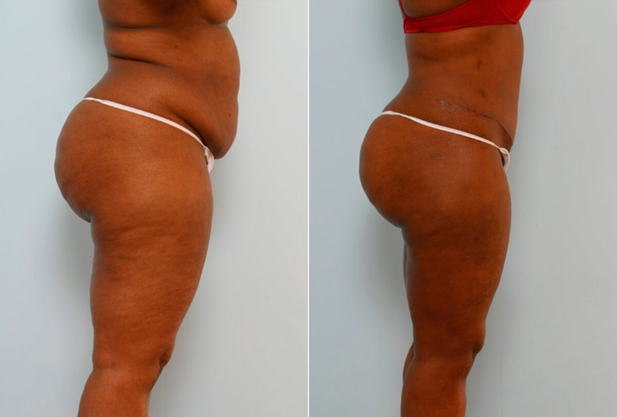 Abdominoplasty before and after photos in Houston, TX, Patient 24342