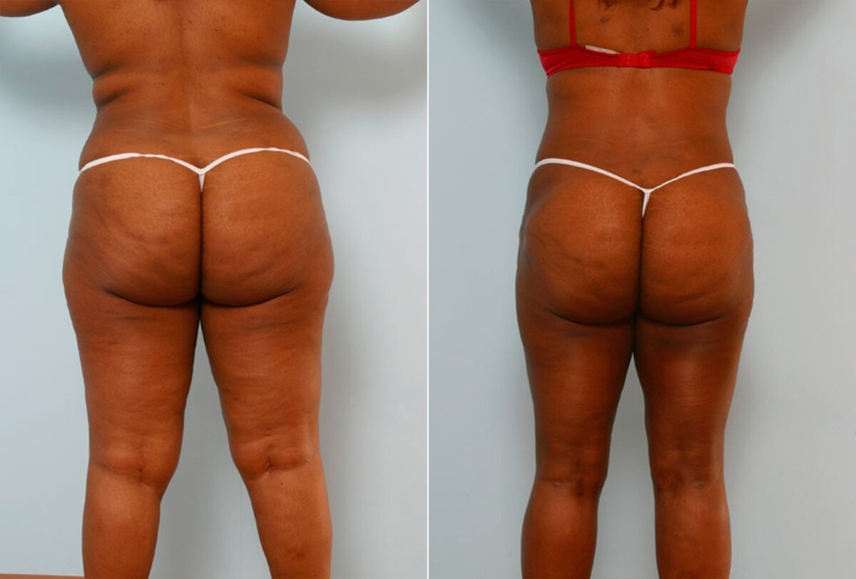 Abdominoplasty before and after photos in Houston, TX, Patient 24342