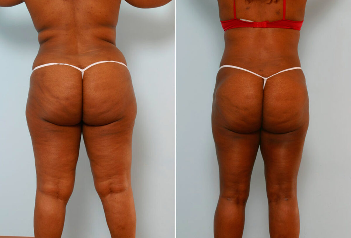 Tummy Tuck/Abdominoplasty before and after photos in Houston, TX, Patient 24342