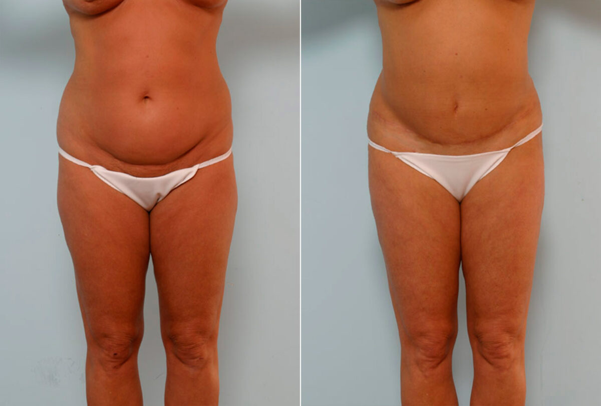 Abdominoplasty before and after photos in Houston, TX, Patient 24351