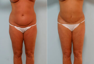 Tummy Tuck/Abdominoplasty before and after photos in Houston, TX, Patient 24351
