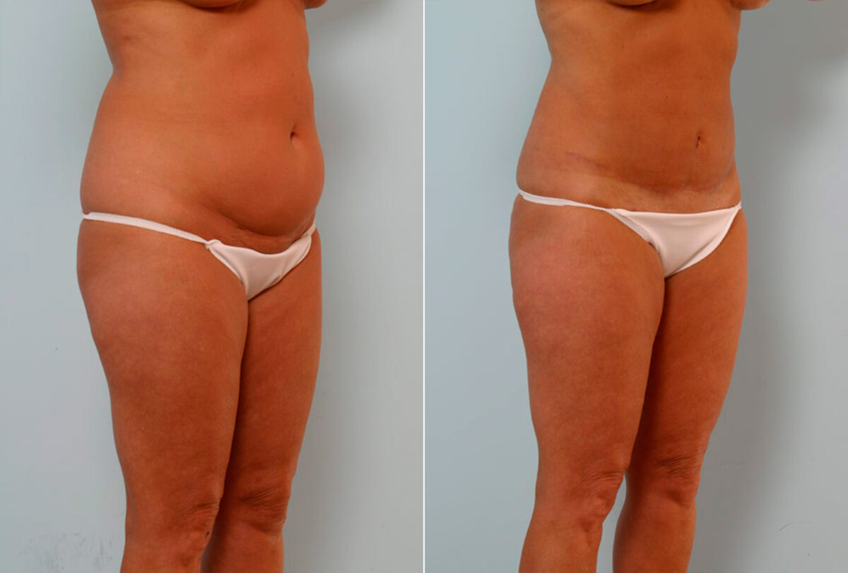 Abdominoplasty before and after photos in Houston, TX, Patient 24351