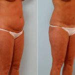 Abdominoplasty before and after photos in Houston, TX, Patient 24351