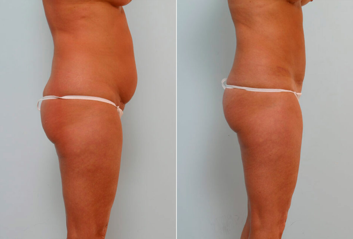 Abdominoplasty before and after photos in Houston, TX, Patient 24351