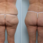 Back Lift before and after photos in Houston, TX, Patient 58655
