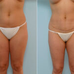 Abdominoplasty before and after photos in Houston, TX, Patient 24358