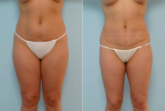 Abdominoplasty before and after photos in Houston, TX, Patient 24358