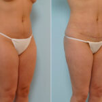 Abdominoplasty before and after photos in Houston, TX, Patient 24358