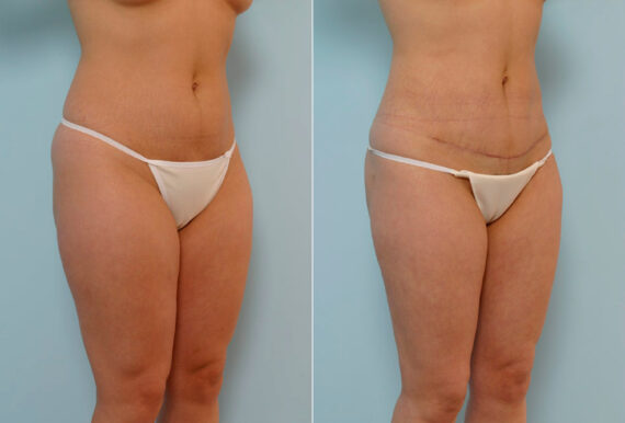 Abdominoplasty before and after photos in Houston, TX, Patient 24358