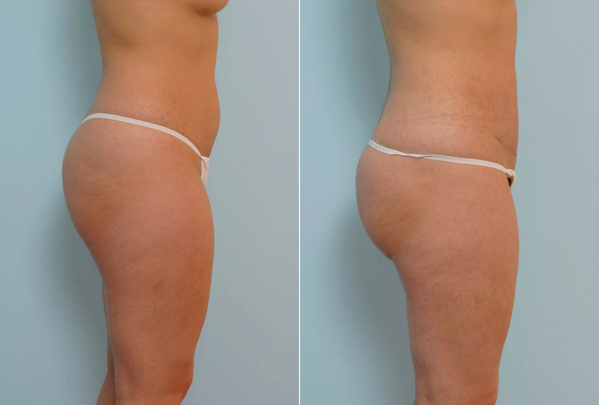 Tummy Tuck/Abdominoplasty before and after photos in Houston, TX, Patient 24358