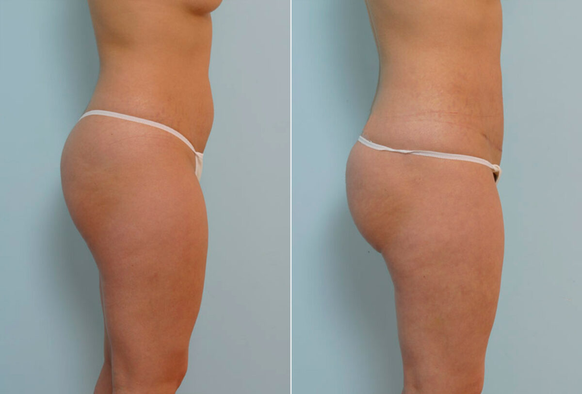 Abdominoplasty before and after photos in Houston, TX, Patient 24358