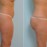 Abdominoplasty before and after photos in Houston, TX, Patient 24358