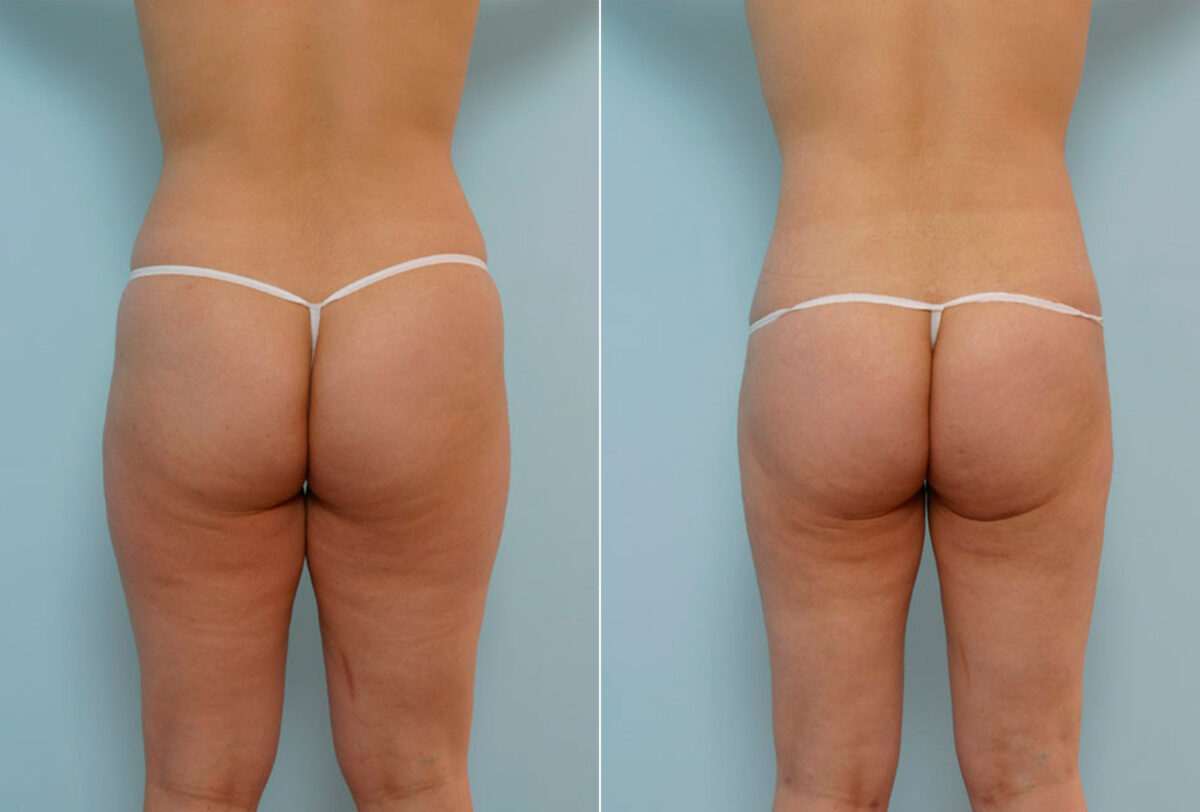 Abdominoplasty before and after photos in Houston, TX, Patient 24358