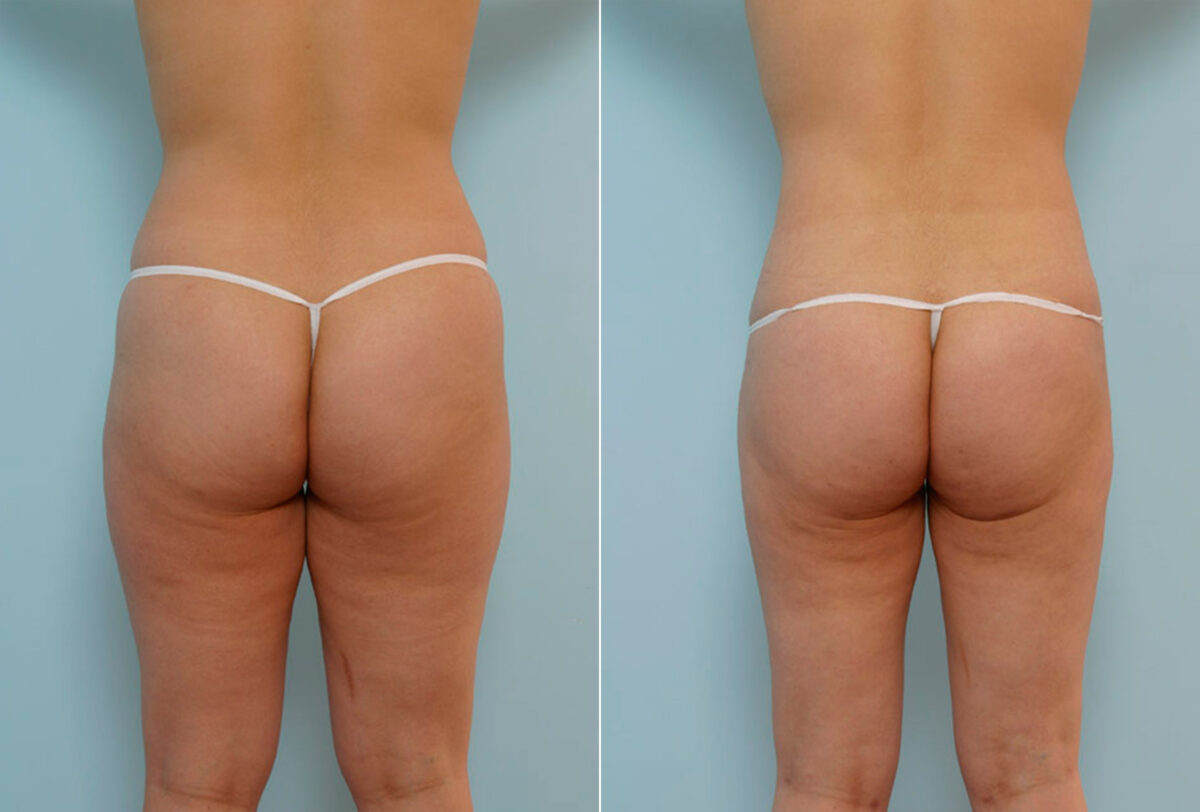 Tummy Tuck/Abdominoplasty before and after photos in Houston, TX, Patient 24358