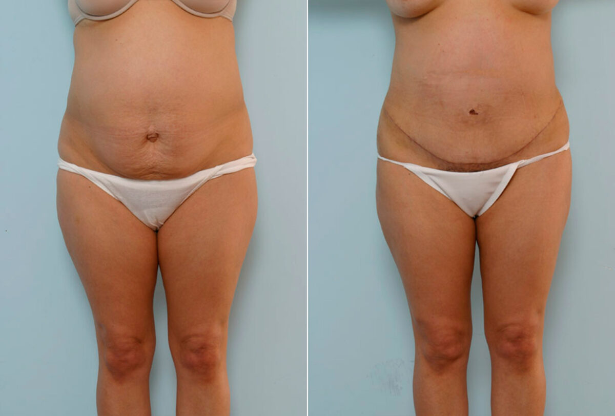 Abdominoplasty before and after photos in Houston, TX, Patient 24367