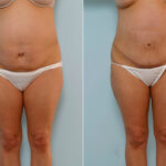 Abdominoplasty before and after photos in Houston, TX, Patient 24367