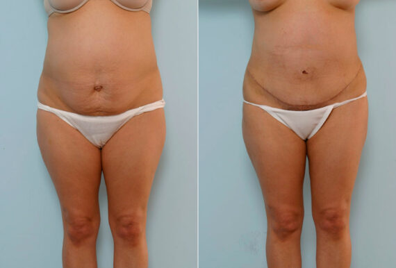 Tummy Tuck/Abdominoplasty before and after photos in Houston, TX, Patient 24367